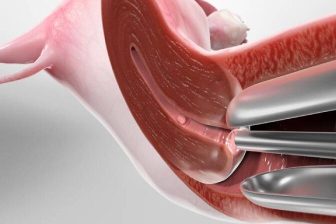 Hysteroscopy Treatment | Understanding Hysteroscopy What You Need to Know? - Dr. Shraddha Galgali